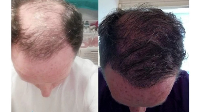 Ağrılı Yükselen Hair, Saç Ekim Merkezi Almanya’da Şube Açıyor!